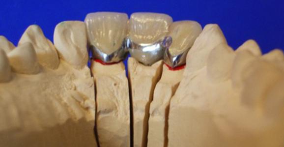 prothèses dentaires