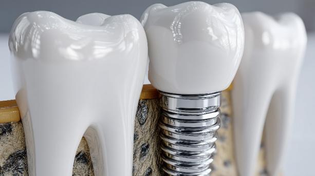 conception implant dentaire Douai conception implant dentaire Douai