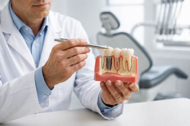 implants dentaires implants dentaires