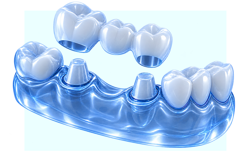 implant numérique