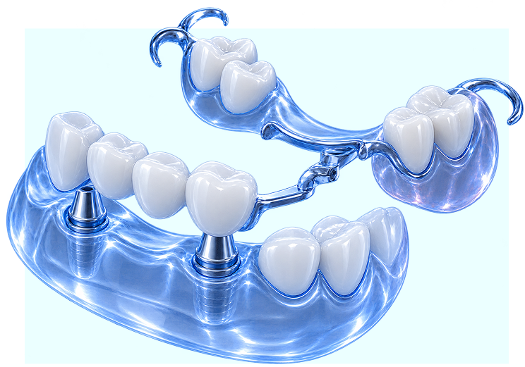 prothèse 3D