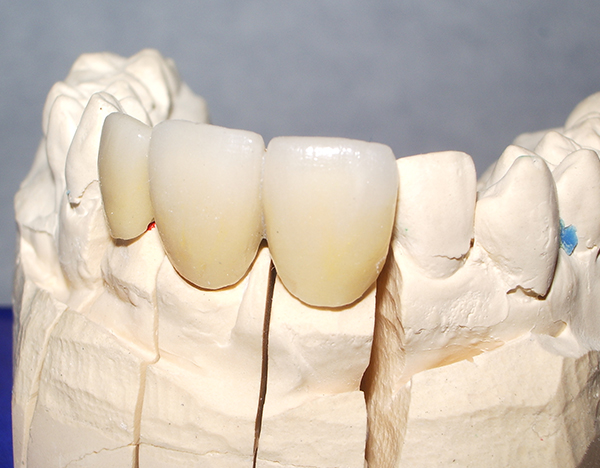 Prothèses dentaires conjointes